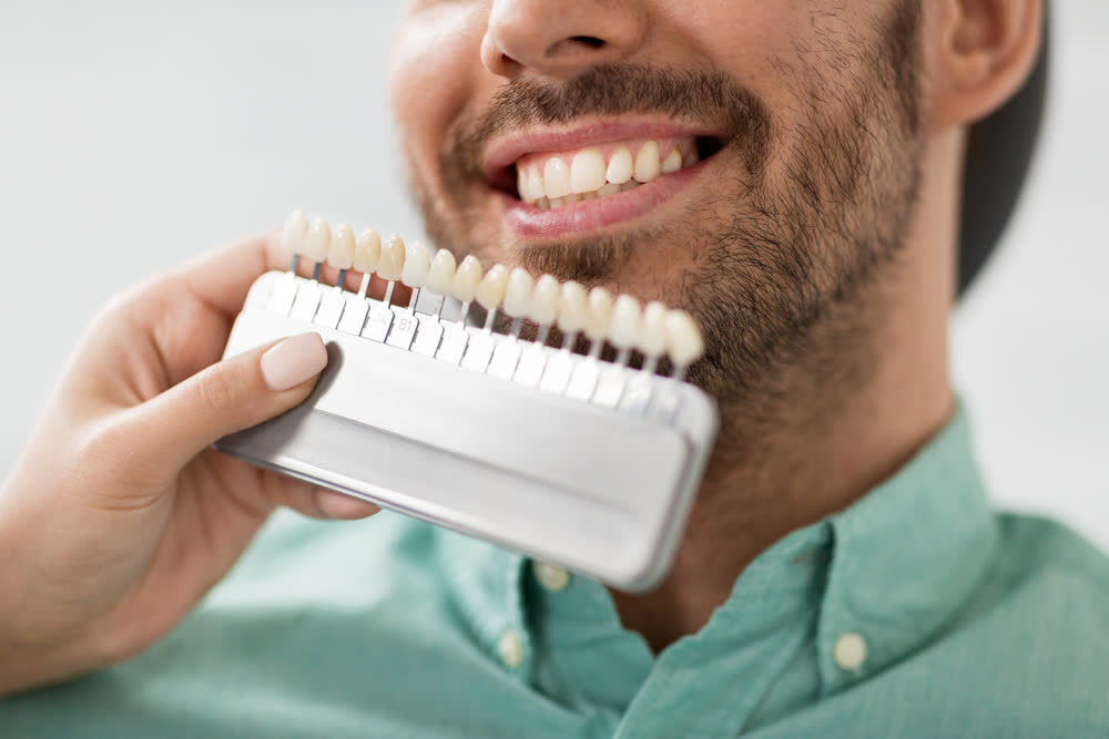 Dental veneers