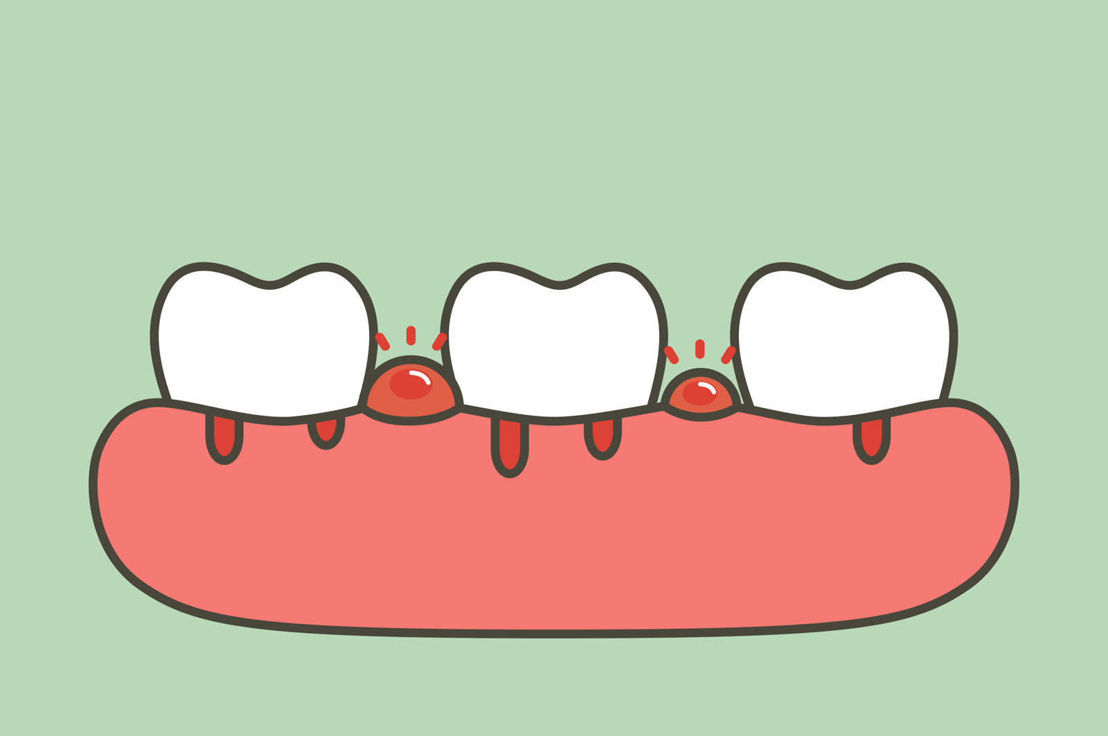 Gum disease treatment