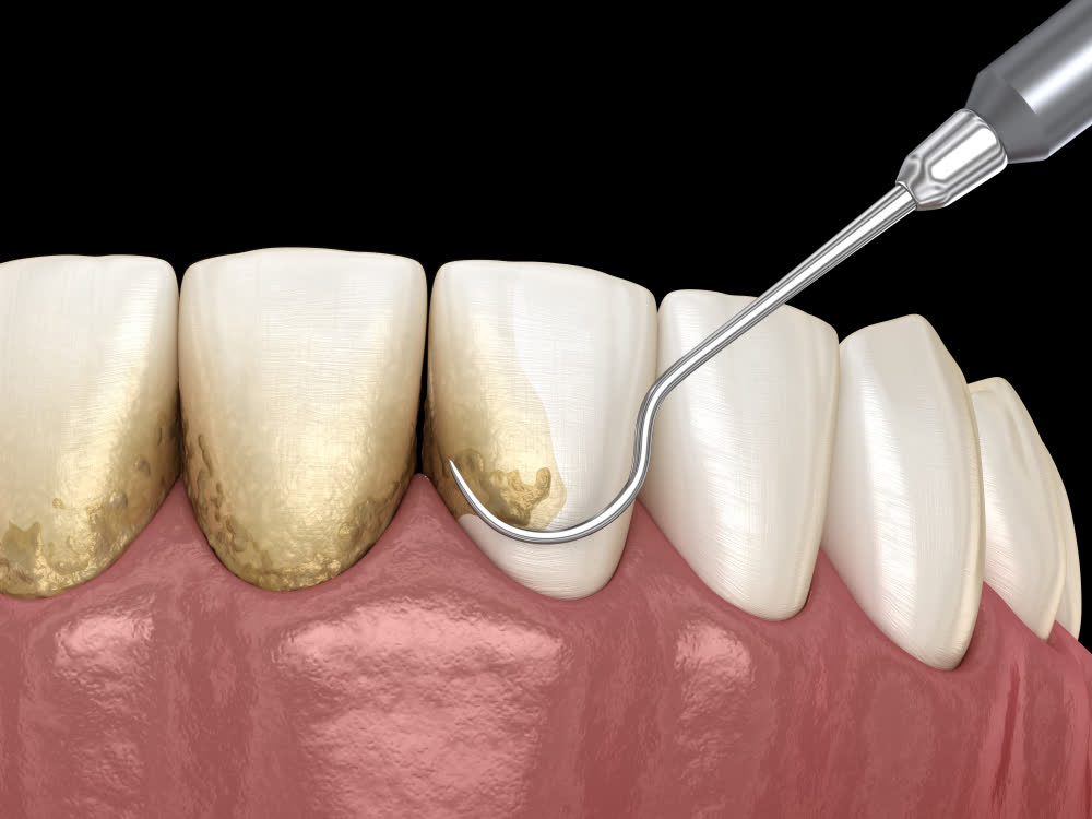 Dental scaling treatment
