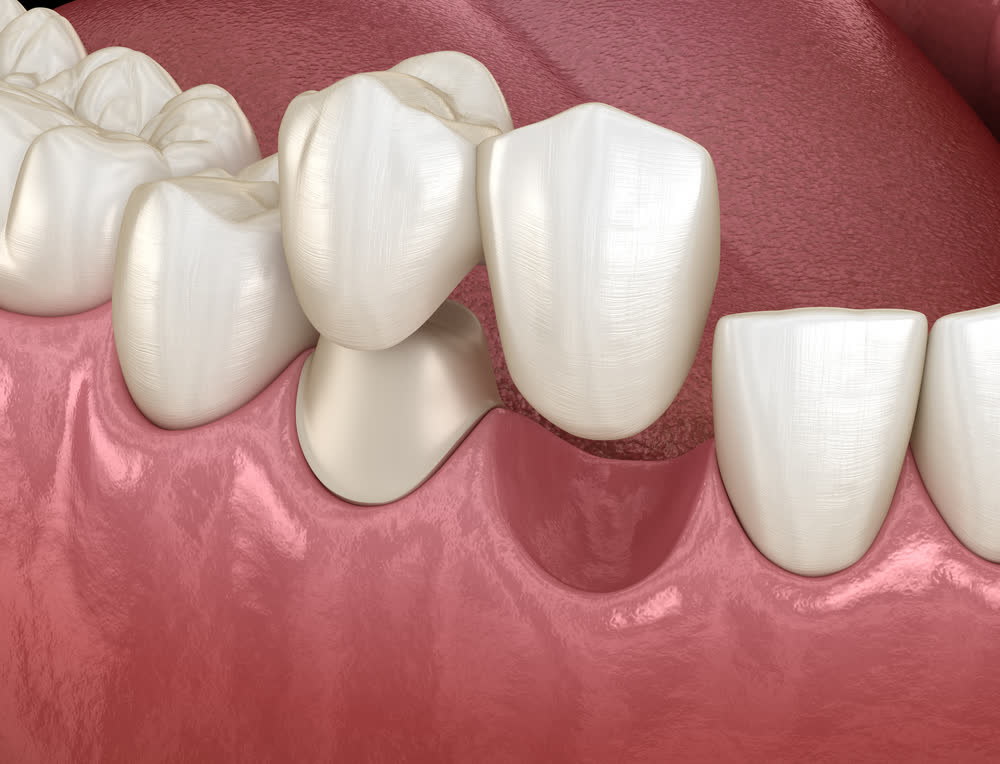 Dental crowns and bridges