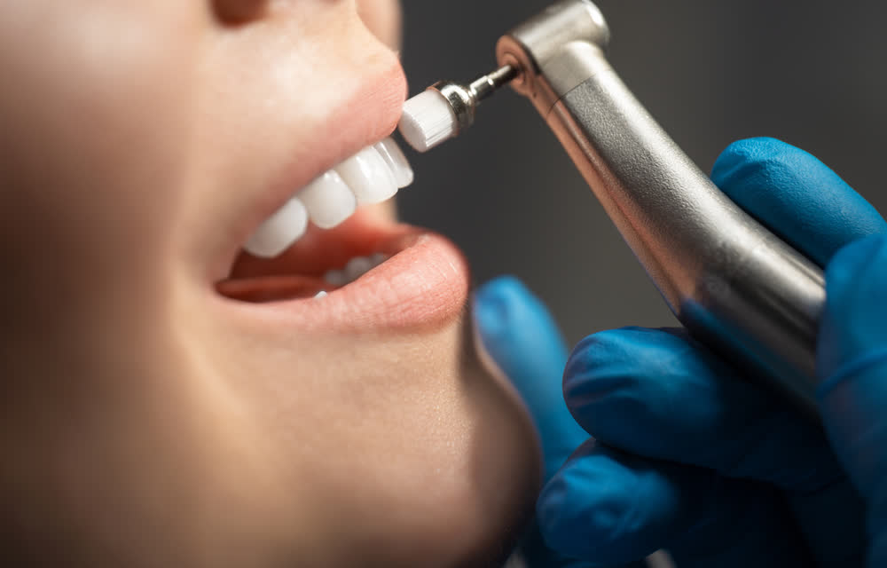 Dental polishing treatment