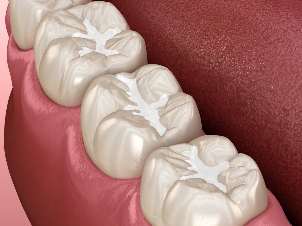Tooth-colored cosmetic filling
