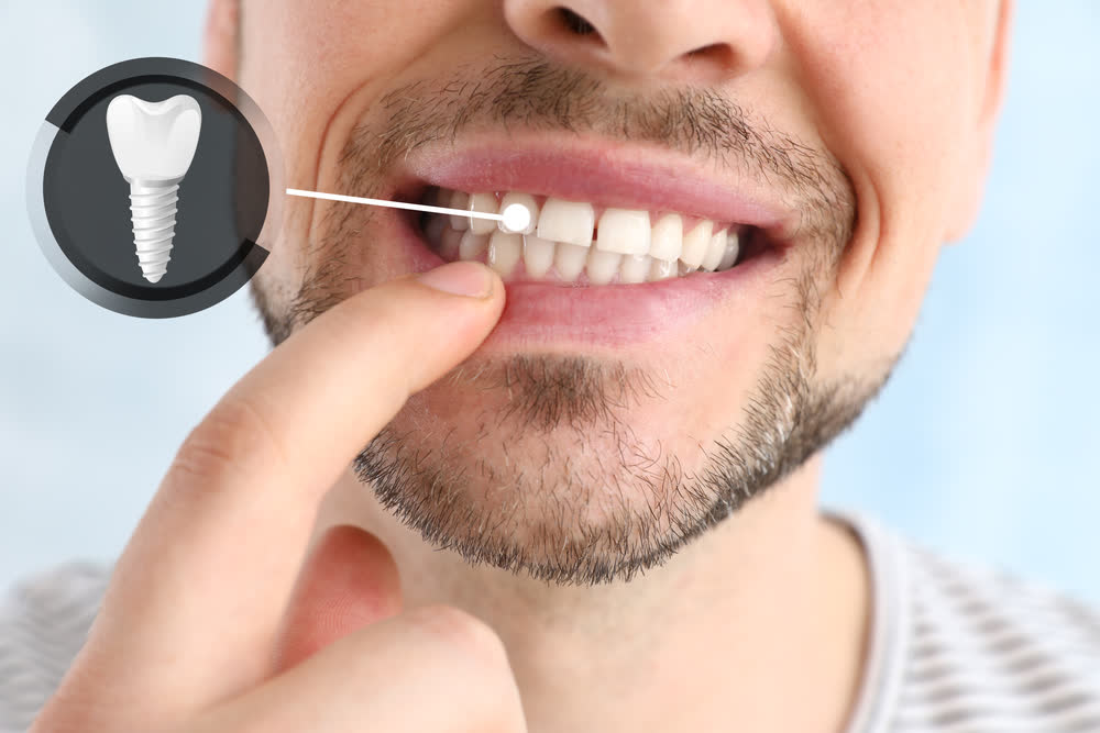 Dental implants treatment in Saginaw
