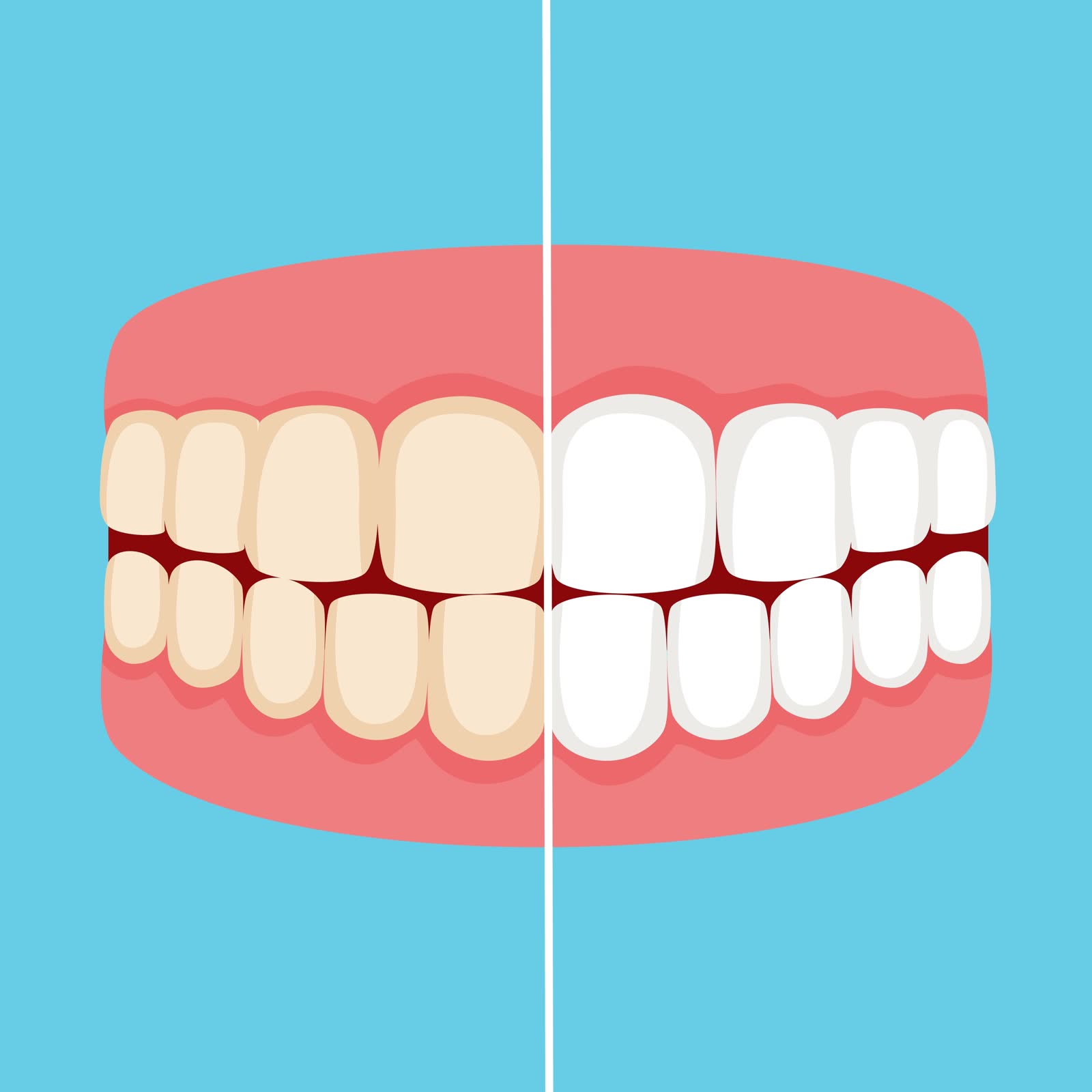 Professional teeth whitening