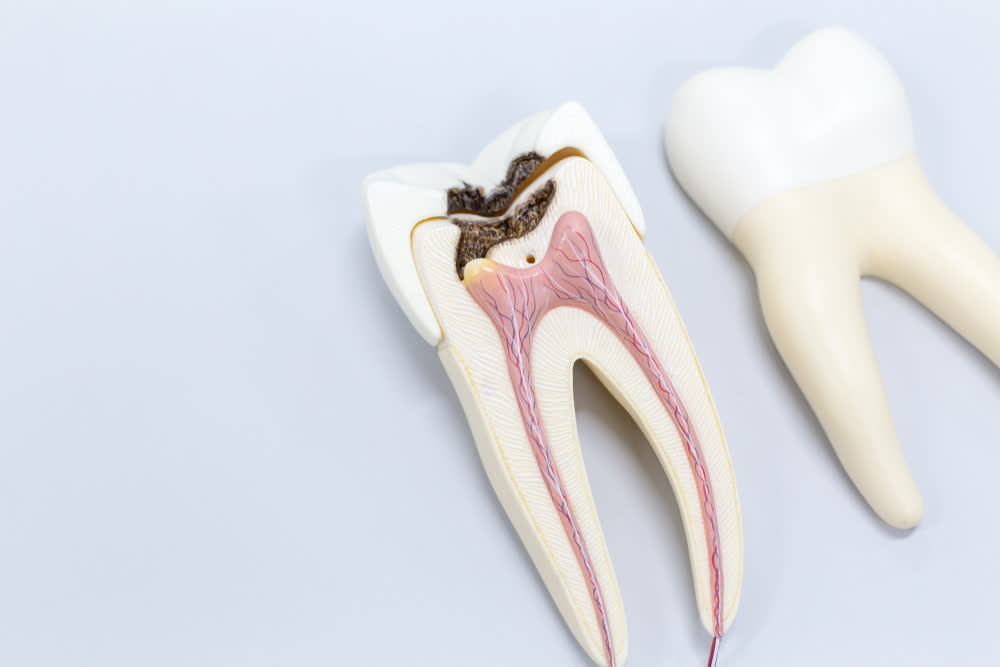 Root canal treatment in Saginaw